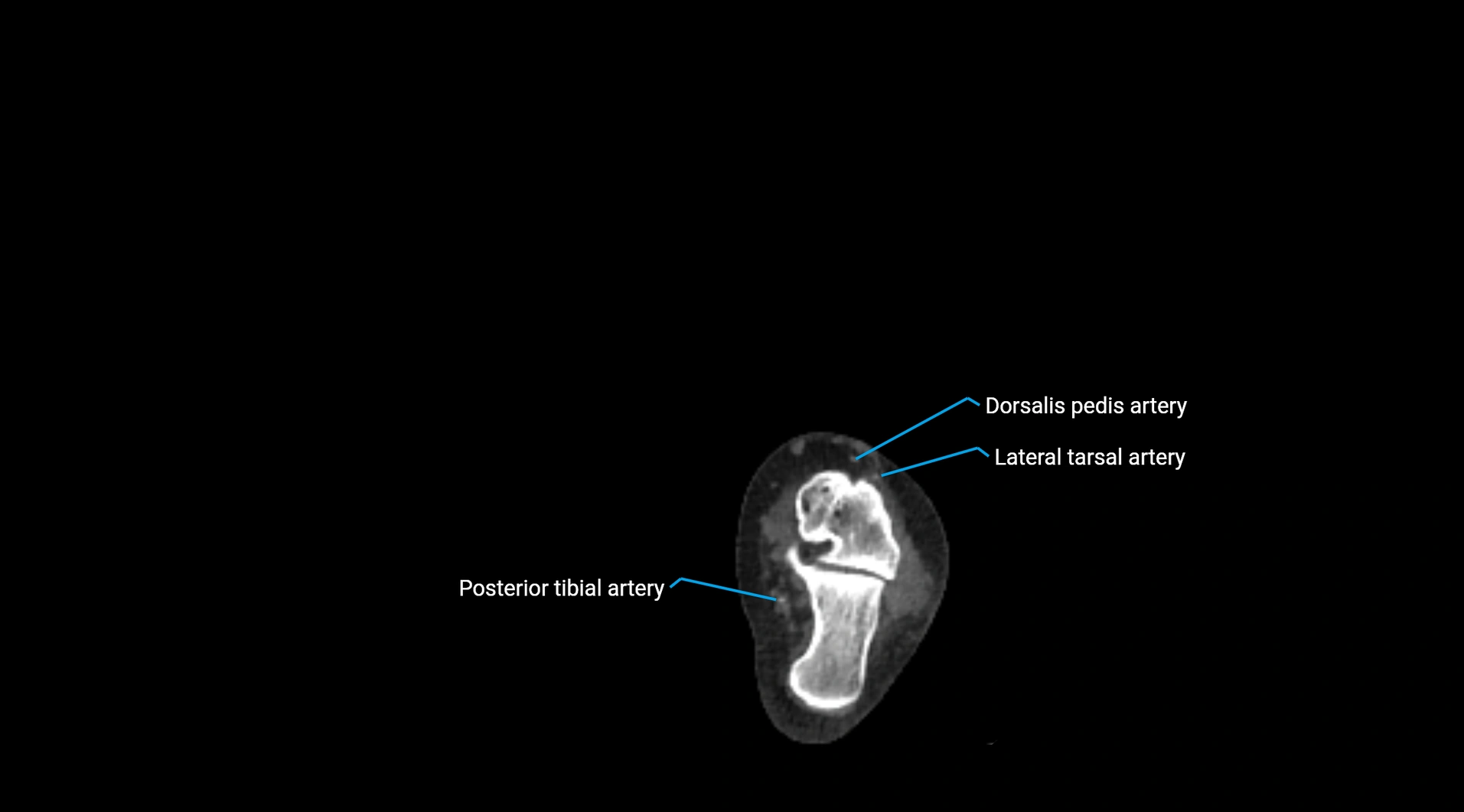CTA lower limb cross sectional anatomy labelled image _278.webp